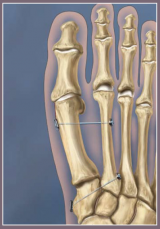 Mini TightRope For Hallux Valgus Correction and Lisfranc Ligament Repair