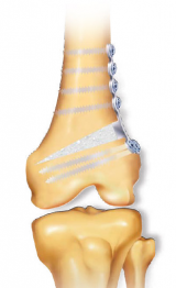 Distal Femoral Opening Wedge Osteotomy