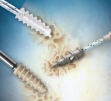 The Fully Threaded Family of Soft Tissue Repair Anchors