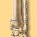 TightRope Syndesmosis Fixation