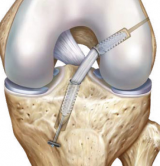 All-Inside ACL RetroConstruction with Bone-Tendon-Bone Grafts