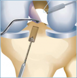 RetroDrill for Anatomic Socket and Tunnel Creation in Cruciate Ligament Reconstruction