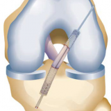 Transtibial All-Inside ACL RetroConstruction