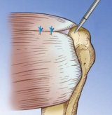 Double Row Rotator Cuff Repair using the Bio-Corkscrew FT