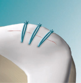 Arthroscopic All-Inside Meniscal Repair with the Meniscal Viper and DartStick