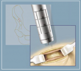 Illiac Crest Bone Graft Harvesting