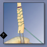 SpeedWhip Technique with FiberLoop