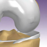 Single Use OATS (Osteochondral Autograft Transfer System)