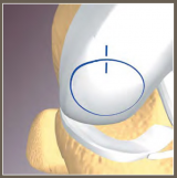 Allograft OATS (Osteochondral Autograft Transfer System)