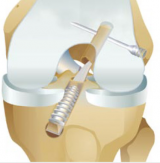 Bone Tendon Bone TransFix II ACL Reconstruction