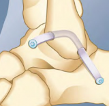 Bio-Tenodesis Screw Fixation in Tendon Enhanced Ankle Ligament Reconstruction