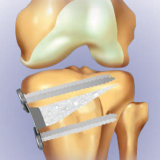 Tibial Opening Wedge Osteotomy System with Titanium Plates and Screws and HATriC Osteotomy Wedge