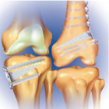 Tibial & Femoral Opening Wedge Osteotomy System