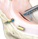 Arthroscopic Meniscal Repair using the Meniscal Cinch