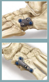 Midfoot Plating Techniques