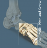 Low Profile Plate and Screw System