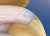 Knotless Single Row Rotator Cuff Repair using the PushLock and FiberTape