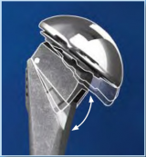 Univers II Total Shoulder System