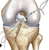 Arthroscopic Protector Meniscus Suturing